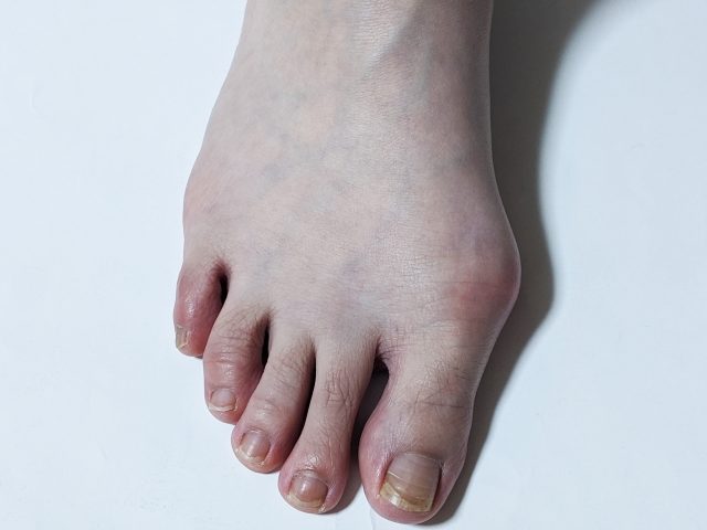 外反母趾は女性だけの疾患ではありません。　江東区西大島の整骨院